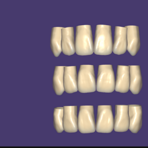 Tooth Library v1 for Exocad Software